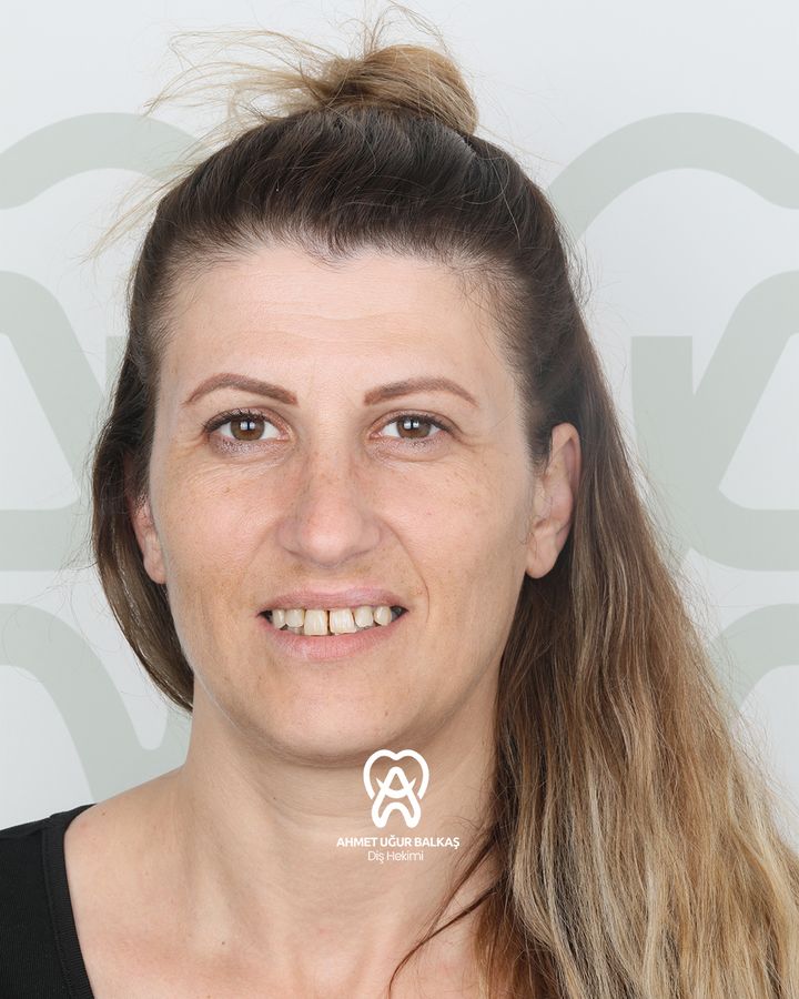 Daniela — gülüş tasarımı öncesi