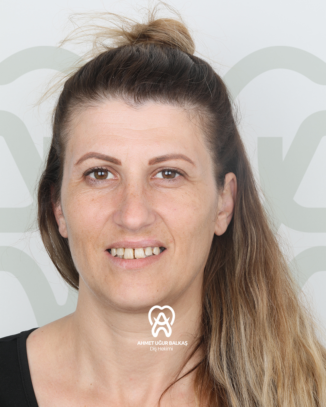 Daniela — gülüş tasarımı öncesi · Dt. Ahmet Uğur Balkaş